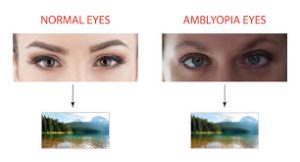 HOW TO PREVENT AMBLYOPIA