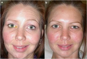 Treatment for facial drooping