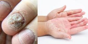 Fingernails common diseases