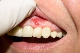 Complications for type 2 diabetes