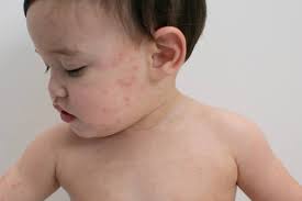 Abdominal pain and children
