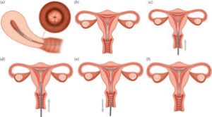iud side effects
