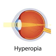 Hyperopia or long sightedness