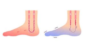 Types of Numbness