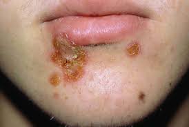 Deworming signs and medications