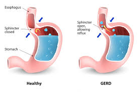 What causes sore throats