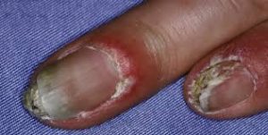 Fingernails common diseases