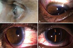 Hyperopia or long sightedness
