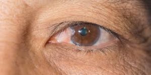 Myopia or shortsightedness