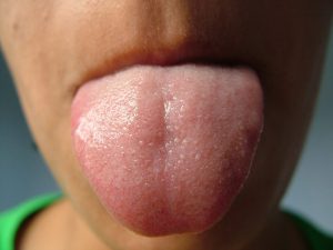 Excessive salivation