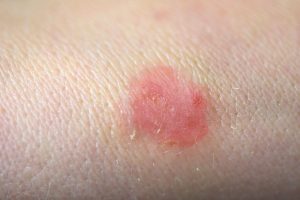 Ringworm diagnosis
