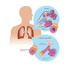 Acute bronchitis