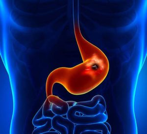 Ulcer causes and types