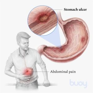 Ulcer causes and types