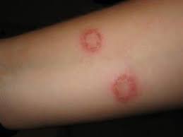 Ringworm diagnosis