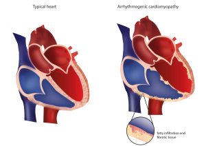 Risk Factors of Cardiomyopathy