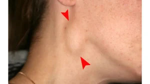 Types of Lumps