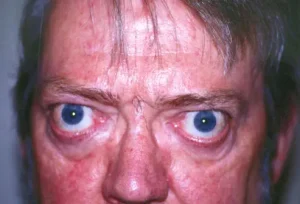 Analysing Graves Disease