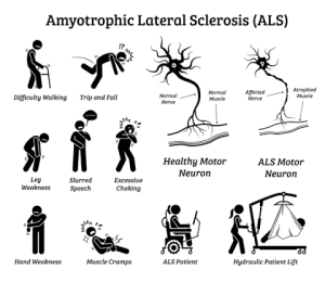 ALS Risk Factors