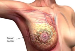 Understanding Breast Lumps