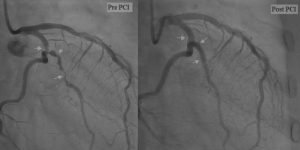 Analysing Coronary Angiography
