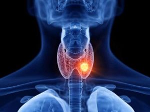 Thyroid Nodules Risk Factors
