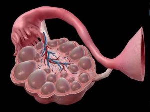 FACTS ABOUT PCOS