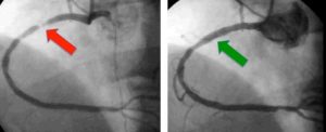 Treatment Tips for CAD