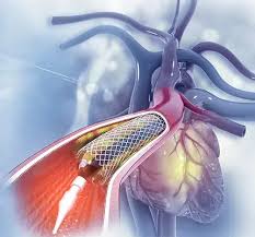 Treatment Tips for CAD