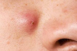 Skin and Abnormal Growths
