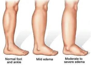 Swelling and Edema Early Signs