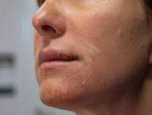 Relieves for Actinic keratosis