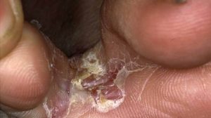 Fungal Infections and Treatment