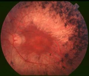 Retinal Disorder Diagnosis