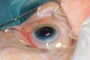 Common Symptoms of Cataracts