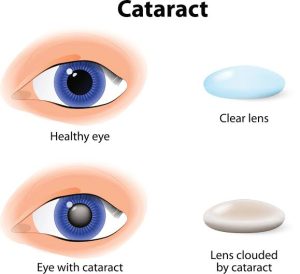 Common Symptoms of Cataracts